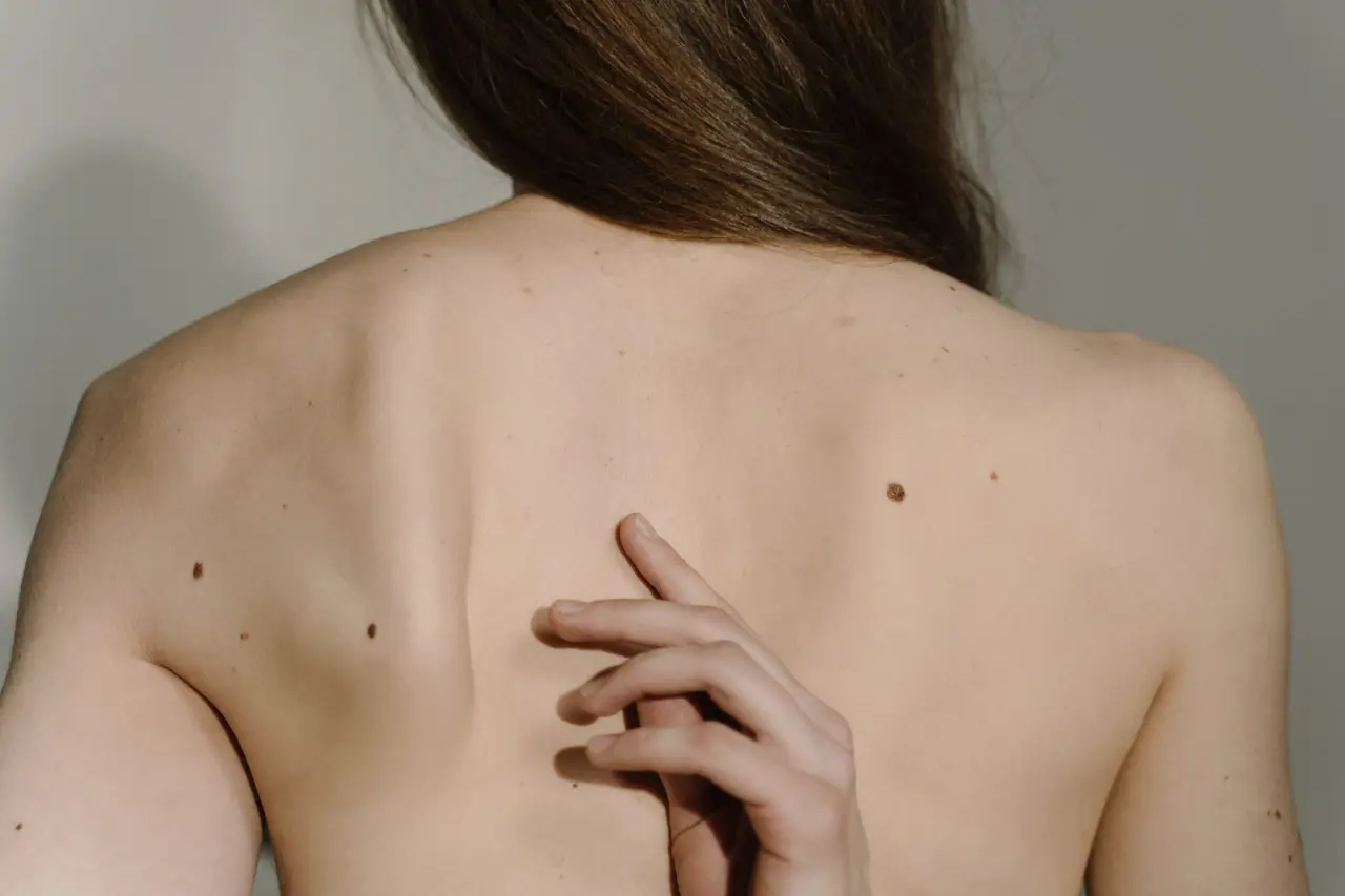Moles on a Person's Bare Back